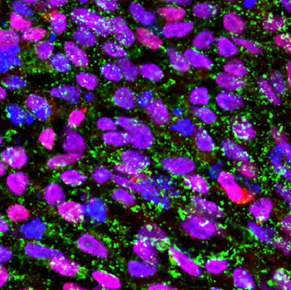 Immunofluorescent image of iPSC line generated from a Parkinson's patient labeled with DSHB antibody MC-813-70 (SSEA-4) against stage-specific embryonic antigen 4 (green). PMID: 32305865, Fig. 1C.
